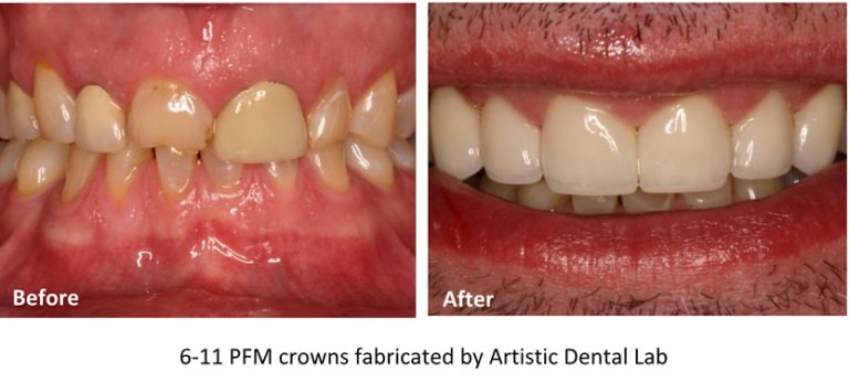 PFM and Full Cast - Artistic Dental Lab